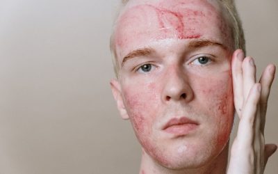 Maseczki oczyszczające a trądzik – co warto wiedzieć?
